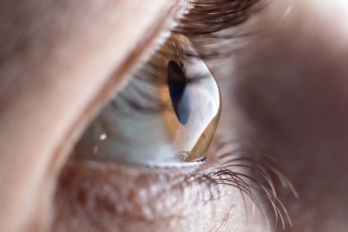 Keratoconus - eye disease, thinning of the cornea in the form of a cone.